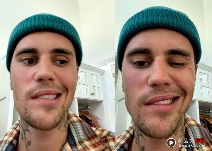 健康｜翻白眼、嘴巴合不拢，Justin Bieber患这罕见带状孢疹并发症！ 更多热点 图2张